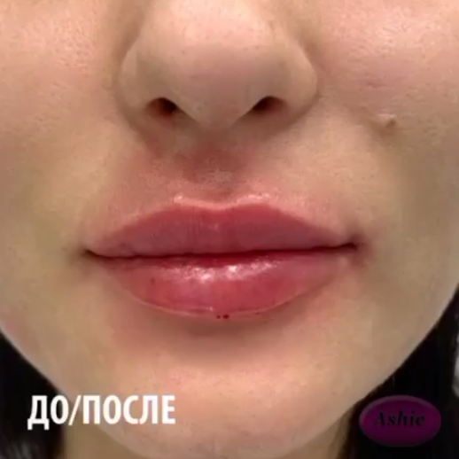 Процедура увеличения губ гиалуроновой кислотой