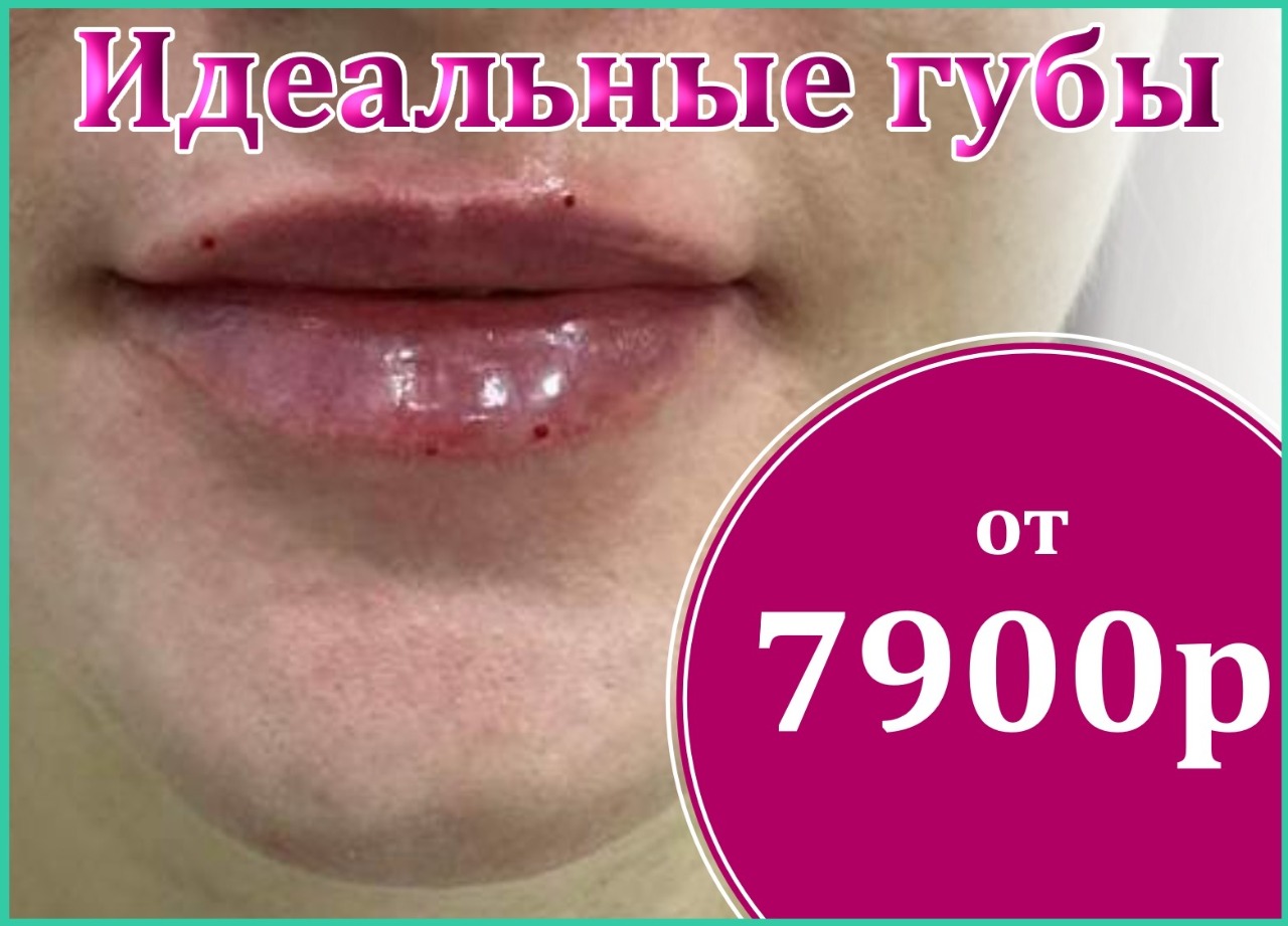Увеличение губ гиалуроновой кислотой в Иркутске