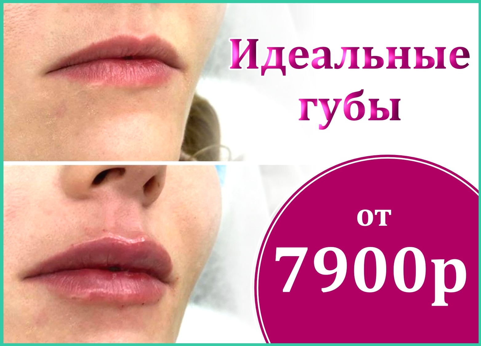 Увеличение губ гиалуроновой кислотой в Иркутске